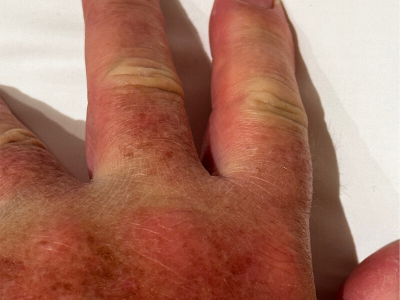 Swollen hand from lionfish sting